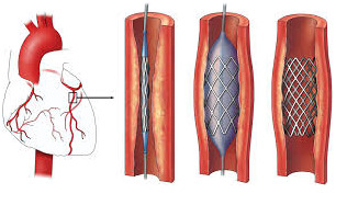Coronary-Angioplasty-and-Stenting1