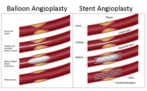 angioplasty-stenting-new-hyde-park-ny-300x185